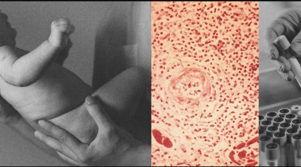 700% Rise in Congenital Syphilis